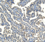 IHC analysis of ODF2 using anti-ODF2 antibody. ODF2 was detected in a paraffin-embedded section of human ovarian cancer tissue. Heat mediated antigen retrieval was performed in EDTA buffer (pH 8.0, epitope retrieval solution). The tissue section was blocked with 10% goat serum. The tissue section was then incubated with 2 ug/ml rabbit anti-ODF2 antibody overnight at 4oC. Peroxidase Conjugated Goat Anti-rabbit IgG was used as secondary antibody and incubated for 30 minutes at 37oC. The tissue section was developed using an HRP secondary and DAB substrate.