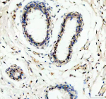 IHC analysis of FUBP1 using anti-FUBP1 antibody. FUBP1 was detected in a paraffin-embedded section of human breast cancer tissue. Heat mediated antigen retrieval was performed in EDTA buffer (pH 8.0, epitope retrieval solution). The tissue section was blocked with 10% goat serum. The tissue section was then incubated with 2 ug/ml rabbit anti-FUBP1 antibody overnight at 4oC. Peroxidase Conjugated Goat Anti-rabbit IgG was used as secondary antibody and incubated for 30 minutes at 37oC. The tissue section was developed using an HRP secondary and DAB substrate.