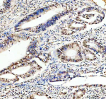IHC analysis of FUBP1 using anti-FUBP1 antibody. FUBP1 was detected in a paraffin-embedded section of human colon cancer tissue. Heat mediated antigen retrieval was performed in EDTA buffer (pH 8.0, epitope retrieval solution). The tissue section was blocked with 10% goat serum. The tissue section was then incubated with 2 ug/ml rabbit anti-FUBP1 antibody overnight at 4oC. Peroxidase Conjugated Goat Anti-rabbit IgG was used as secondary antibody and incubated for 30 minutes at 37oC. The tissue section was developed using an HRP secondary and DAB substrate.