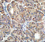 Immunohistochemical staining of TIRAP using anti-TIRAP antibody. TIRAP was detected in a paraffin-embedded section of human liver cancer tissue. Heat mediated antigen retrieval was performed in EDTA buffer (pH 8.0, epitope retrieval solution). The tissue section was blocked with 10% goat serum. The tissue section was then incubated with 2 ug/ml rabbit anti-TIRAP antibody overnight at 4oC. Peroxidase Conjugated Goat Anti-rabbit IgG was used as secondary antibody and incubated for 30 minutes at 37oC. The tissue section was developed using an HRP secondary and DAB substrate.