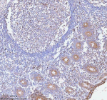 Immunohistochemical staining of HERPUD1 using anti-HERPUD1 antibody. HERPUD1 was detected in a paraffin-embedded section of human appendiceal carcinoid tissue. Heat mediated antigen retrieval was performed in EDTA buffer (pH 8.0, epitope retrieval solution). The tissue section was blocked with 10% goat serum. The tissue section was then incubated with 2 ug/ml rabbit anti-HERPUD1 antibody overnight at 4oC. Peroxidase Conjugated Goat Anti-rabbit IgG was used as secondary antibody and incubated for 30 minutes at 37oC. The tissue section was developed using an HRP secondary and DAB substrate.