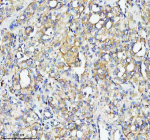 Immunohistochemical staining of TOM1 using anti-TOM1 antibody. TOM1 was detected in a paraffin-embedded section of human thyroid cancer tissue. Heat mediated antigen retrieval was performed in EDTA buffer (pH 8.0, epitope retrieval solution). The tissue section was blocked with 10% goat serum. The tissue section was then incubated with 2 ug/ml rabbit anti-TOM1 antibody overnight at 4oC. Peroxidase Conjugated Goat Anti-rabbit IgG was used as secondary antibody and incubated for 30 minutes at 37oC. The tissue section was developed using an HRP secondary and DAB substrate.