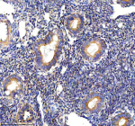 Immunohistochemical staining of PALS1 using anti-PALS1 antibody. PALS1 was detected in a paraffin-embedded section of human endometrial cancer tissue. Heat mediated antigen retrieval was performed in EDTA buffer (pH 8.0, epitope retrieval solution). The tissue section was blocked with 10% goat serum. The tissue section was then incubated with 2 ug/ml rabbit anti-PALS1 antibody overnight at 4oC. Peroxidase Conjugated Goat Anti-rabbit IgG was used as secondary antibody and incubated for 30 minutes at 37oC. The tissue section was developed using an HRP secondary and DAB substrate.