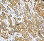 Immunohistochemical staining of RPS21 using anti-RPS21 antibody. RPS21 was detected in a paraffin-embedded section of human liver cancer tissue. Heat mediated antigen retrieval was performed in EDTA buffer (pH 8.0, epitope retrieval solution). The tissue section was blocked with 10% goat serum. The tissue section was then incubated with 2 ug/ml rabbit anti-RPS21 antibody overnight at 4oC. Peroxidase Conjugated Goat Anti-rabbit IgG was used as secondary antibody and incubated for 30 minutes at 37oC. The tissue section was developed using an HRP secondary and DAB substrate.