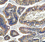 Immunohistochemical staining of TYRO3 using anti-TYRO3 antibody. TYRO3 was detected in a paraffin-embedded section of human colon cancer tissue. Heat mediated antigen retrieval was performed in EDTA buffer (pH 8.0, epitope retrieval solution). The tissue section was blocked with 10% goat serum. The tissue section was then incubated with 2 ug/ml rabbit anti-TYRO3 antibody overnight at 4oC. Peroxidase Conjugated Goat Anti-rabbit IgG was used as secondary antibody and incubated for 30 minutes at 37oC. The tissue section was developed using an HRP secondary and DAB substrate.