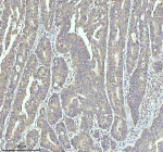 Immunohistochemical staining of MYH14 using anti-MYH14 antibody. MYH14 was detected in a paraffin-embedded section of human colon cancer tissue. Heat mediated antigen retrieval was performed in EDTA buffer (pH 8.0, epitope retrieval solution). The tissue section was blocked with 10% goat serum. The tissue section was then incubated with 2 ug/ml rabbit anti-MYH14 antibody overnight at 4oC. Peroxidase Conjugated Goat Anti-rabbit IgG was used as secondary antibody and incubated for 30 minutes at 37oC. The tissue section was developed using an HRP secondary and DAB substrate.