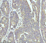 Immunohistochemical staining of MYH14 using anti-MYH14 antibody. MYH14 was detected in a paraffin-embedded section of human colon cancer tissue. Heat mediated antigen retrieval was performed in EDTA buffer (pH 8.0, epitope retrieval solution). The tissue section was blocked with 10% goat serum. The tissue section was then incubated with 2 ug/ml rabbit anti-MYH14 antibody overnight at 4oC. Peroxidase Conjugated Goat Anti-rabbit IgG was used as secondary antibody and incubated for 30 minutes at 37oC. The tissue section was developed using an HRP secondary and DAB substrate.