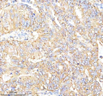Immunohistochemical staining of Choriogonadotropin alpha/CGA using anti-CGA antibody. Choriogonadotropin alpha/CGA was detected in a paraffin-embedded section of human stomach cancer tissue. Heat mediated antigen retrieval was performed in EDTA buffer (pH 8.0, epitope retrieval solution). The tissue section was blocked with 10% goat serum. The tissue section was then incubated with 2 ug/ml rabbit anti-CGA antibody overnight at 4oC. Peroxidase Conjugated Goat Anti-rabbit IgG was used as secondary antibody and incubated for 30 minutes at 37oC. The tissue section was developed using an HRP secondary and DAB substrate.
