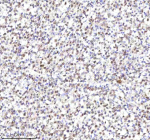 Immunohistochemical staining of RLIM using anti-RLIM antibody. RLIM was detected in a paraffin-embedded section of diffuse large B-cell lymphoma of human intestine tissue. Heat mediated antigen retrieval was performed in EDTA buffer (pH 8.0, epitope retrieval solution). The tissue section was blocked with 10% goat serum. The tissue section was then incubated with 2 ug/ml rabbit anti-RLIM antibody overnight at 4oC. Peroxidase Conjugated Goat Anti-rabbit IgG was used as secondary antibody and incubated for 30 minutes at 37oC. The tissue section was developed using an HRP secondary and DAB substrate.
