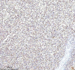 Immunohistochemical staining of RLIM using anti-RLIM antibody. RLIM was detected in a paraffin-embedded section of diffuse large B-cell lymphoma of human intestine tissue. Heat mediated antigen retrieval was performed in EDTA buffer (pH 8.0, epitope retrieval solution). The tissue section was blocked with 10% goat serum. The tissue section was then incubated with 2 ug/ml rabbit anti-RLIM antibody overnight at 4oC. Peroxidase Conjugated Goat Anti-rabbit IgG was used as secondary antibody and incubated for 30 minutes at 37oC. The tissue section was developed using an HRP secondary and DAB substrate.
