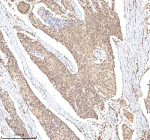Immunohistochemical staining of RLIM using anti-RLIM antibody. RLIM was detected in a paraffin-embedded section of human esophageal squamous carcinoma tissue. Heat mediated antigen retrieval was performed in EDTA buffer (pH 8.0, epitope retrieval solution). The tissue section was blocked with 10% goat serum. The tissue section was then incubated with 2 ug/ml rabbit anti-RLIM antibody overnight at 4oC. Peroxidase Conjugated Goat Anti-rabbit IgG was used as secondary antibody and incubated for 30 minutes at 37oC. The tissue section was developed using an HRP secondary and DAB substrate.