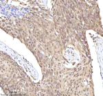 Immunohistochemical staining of RLIM using anti-RLIM antibody. RLIM was detected in a paraffin-embedded section of human esophageal squamous carcinoma tissue. Heat mediated antigen retrieval was performed in EDTA buffer (pH 8.0, epitope retrieval solution). The tissue section was blocked with 10% goat serum. The tissue section was then incubated with 2 ug/ml rabbit anti-RLIM antibody overnight at 4oC. Peroxidase Conjugated Goat Anti-rabbit IgG was used as secondary antibody and incubated for 30 minutes at 37oC. The tissue section was developed using an HRP secondary and DAB substrate.
