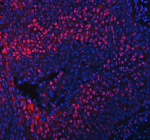 Immunofluorescent staining of RLIM using anti-RLIM antibody (red). RLIM was detected in a paraffin-embedded section of human esophageal squamous carcinoma tissue. Heat mediated antigen retrieval was performed in EDTA buffer (pH 8.0, epitope retrieval solution). The tissue section was blocked with 10% goat serum. The tissue section was then incubated with 5 ug/ml rabbit anti-RLIM antibody overnight at 4oC. DyLight 550 Conjugated Goat Anti-Rabbit IgG was used as secondary antibody at 1:500 dilution and incubated for 30 minutes at 37oC. The section was counterstained with DAPI nuclear stain (blue). Visualize using a fluorescence microscope and filter sets appropriate for the label used.