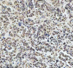 Immunohistochemical staining of RAD51AP1 using anti-RAD51AP1 antibody. RAD51AP1 was detected in a paraffin-embedded section of human ovarian cancer tissue. Heat mediated antigen retrieval was performed in EDTA buffer (pH 8.0, epitope retrieval solution). The tissue section was blocked with 10% goat serum. The tissue section was then incubated with 2 ug/ml rabbit anti-RAD51AP1 antibody overnight at 4oC. Peroxidase Conjugated Goat Anti-rabbit IgG was used as secondary antibody and incubated for 30 minutes at 37oC. The tissue section was developed using an HRP secondary and DAB substrate.