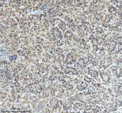 Immunohistochemical staining of RAD51AP1 using anti-RAD51AP1 antibody. RAD51AP1 was detected in a paraffin-embedded section of human ovarian cancer tissue. Heat mediated antigen retrieval was performed in EDTA buffer (pH 8.0, epitope retrieval solution). The tissue section was blocked with 10% goat serum. The tissue section was then incubated with 2 ug/ml rabbit anti-RAD51AP1 antibody overnight at 4oC. Peroxidase Conjugated Goat Anti-rabbit IgG was used as secondary antibody and incubated for 30 minutes at 37oC. The tissue section was developed using an HRP secondary and DAB substrate.