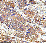 Immunohistochemical staining of SYAP1 using anti-SYAP1 antibody. SYAP1 was detected in a paraffin-embedded section of human liver cancer tissue. Heat mediated antigen retrieval was performed in EDTA buffer (pH 8.0, epitope retrieval solution). The tissue section was blocked with 10% goat serum. The tissue section was then incubated with 2 ug/ml rabbit anti-SYAP1 antibody overnight at 4oC. Peroxidase Conjugated Goat Anti-rabbit IgG was used as secondary antibody and incubated for 30 minutes at 37oC. The tissue section was developed using an HRP secondary and DAB substrate.