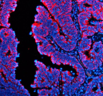Immunofluorescent staining of TRIOBP using anti-TRIOBP antibody (red). TRIOBP was detected in a paraffin-embedded section of human colon cancer tissue. Heat mediated antigen retrieval was performed in EDTA buffer (pH 8.0, epitope retrieval solution). The tissue section was blocked with 10% goat serum. The tissue section was then incubated with 5 ug/ml rabbit anti-TRIOBP antibody overnight at 4oC. Cy3 Conjugated Goat Anti-Rabbit IgG was used as secondary antibody at 1:500 dilution and incubated for 30 minutes at 37oC. The section was counterstained with DAPI nuclear stain (blue). Visualize using a fluorescence microscope and filter sets appropriate for the label used.
