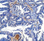 Immunohistochemical staining of TRIOBP using anti-TRIOBP antibody. TRIOBP was detected in a paraffin-embedded section of human colon cancer tissue. Heat mediated antigen retrieval was performed in EDTA buffer (pH 8.0, epitope retrieval solution). The tissue section was blocked with 10% goat serum. The tissue section was then incubated with 2 ug/ml rabbit anti-TRIOBP antibody overnight at 4oC. Peroxidase Conjugated Goat Anti-rabbit IgG was used as secondary antibody and incubated for 30 minutes at 37oC. The tissue section was developed using an HRP secondary and DAB substrate.