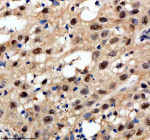 Immunohistochemical staining of PSMD1 using anti-PSMD1 antibody. PSMD1 was detected in a paraffin-embedded section of human bladder cancer tissue. Heat mediated antigen retrieval was performed in EDTA buffer (pH 8.0, epitope retrieval solution). The tissue section was blocked with 10% goat serum. The tissue section was then incubated with 2 ug/ml rabbit anti-PSMD1 antibody overnight at 4oC. Peroxidase Conjugated Goat Anti-rabbit IgG was used as secondary antibody and incubated for 30 minutes at 37oC. The tissue section was developed using an HRP secondary and DAB substrate.