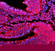 Immunofluorescent staining of PSMD1 using anti-PSMD1 antibody. PSMD1 was detected in a paraffin-embedded section of human colon cancer tissue. Heat mediated antigen retrieval was performed in EDTA buffer (pH 8.0, epitope retrieval solution). The tissue section was blocked with 10% goat serum. The tissue section was then incubated with 5 ug/ml rabbit anti-PSMD1 antibody overnight at 4oC. Cy3 Conjugated Goat Anti-Rabbit IgG was used as secondary antibody at 1:500 dilution and incubated for 30 minutes at 37oC. The section was counterstained with DAPI nuclear stain (blue). Visualize using a fluorescence microscope and filter sets appropriate for the label used.