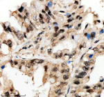 Immunohistochemical staining of PSMD1 using anti-PSMD1 antibody. PSMD1 was detected in a paraffin-embedded section of human lung cancer tissue. Heat mediated antigen retrieval was performed in EDTA buffer (pH 8.0, epitope retrieval solution). The tissue section was blocked with 10% goat serum. The tissue section was then incubated with 2 ug/ml rabbit anti-PSMD1 antibody overnight at 4oC. Peroxidase Conjugated Goat Anti-rabbit IgG was used as secondary antibody and incubated for 30 minutes at 37oC. The tissue section was developed using an HRP secondary and DAB substrate.