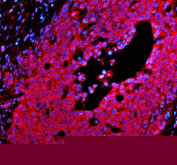 Immunofluorescent staining of PSMD1 using anti-PSMD1 antibody. PSMD1 was detected in a paraffin-embedded section of human ovarian cancer tissue. Heat mediated antigen retrieval was performed in EDTA buffer (pH 8.0, epitope retrieval solution). The tissue section was blocked with 10% goat serum. The tissue section was then incubated with 5 ug/ml rabbit anti-PSMD1 antibody overnight at 4oC. Cy3 Conjugated Goat Anti-Rabbit IgG was used as secondary antibody at 1:500 dilution and incubated for 30 minutes at 37oC. The section was counterstained with DAPI nuclear stain (blue). Visualize using a fluorescence microscope and filter sets appropriate for the label used.