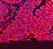 Immunofluorescent staining of PSMD1 using anti-PSMD1 antibody. PSMD1 was detected in a paraffin-embedded section of human liver cancer tissue. Heat mediated antigen retrieval was performed in EDTA buffer (pH 8.0, epitope retrieval solution). The tissue section was blocked with 10% goat serum. The tissue section was then incubated with 5 ug/ml rabbit anti-PSMD1 antibody overnight at 4oC. Cy3 Conjugated Goat Anti-Rabbit IgG was used as secondary antibody at 1:500 dilution and incubated for 30 minutes at 37oC. The section was counterstained with DAPI nuclear stain (blue). Visualize using a fluorescence microscope and filter sets appropriate for the label used.