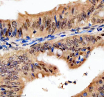 Immunohistochemical staining of PSMD1 using anti-PSMD1 antibody. PSMD1 was detected in a paraffin-embedded section of human colon cancer tissue. Heat mediated antigen retrieval was performed in EDTA buffer (pH 8.0, epitope retrieval solution). The tissue section was blocked with 10% goat serum. The tissue section was then incubated with 2 ug/ml rabbit anti-PSMD1 antibody overnight at 4oC. Peroxidase Conjugated Goat Anti-rabbit IgG was used as secondary antibody and incubated for 30 minutes at 37oC. The tissue section was developed using an HRP secondary and DAB substrate.