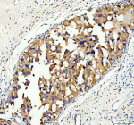 Immunohistochemical staining of Serine racemase using anti-Serine racemase antibody. Serine racemase was detected in a paraffin-embedded section of human breast cancer tissue. Heat mediated antigen retrieval was performed in EDTA buffer (pH 8.0, epitope retrieval solution). The tissue section was blocked with 10% goat serum. The tissue section was then incubated with 2 ug/ml rabbit anti-Serine racemase antibody overnight at 4oC. Peroxidase Conjugated Goat Anti-rabbit IgG was used as secondary antibody and incubated for 30 minutes at 37oC. The tissue section was developed using an HRP secondary and DAB substrate.