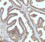 Immunohistochemical staining of IGFL3 using anti-IGFL3 antibody. IGFL3 was detected in a paraffin-embedded section of human prostate cancer tissue. Heat mediated antigen retrieval was performed in EDTA buffer (pH 8.0, epitope retrieval solution). The tissue section was blocked with 10% goat serum. The tissue section was then incubated with 2 ug/ml rabbit anti-IGFL3 antibody overnight at 4oC. Peroxidase Conjugated Goat Anti-rabbit IgG was used as secondary antibody and incubated for 30 minutes at 37oC. The tissue section was developed using an HRP secondary and DAB substrate.