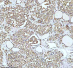 Immunohistochemical staining of IGFL3 using anti-IGFL3 antibody. IGFL3 was detected in a paraffin-embedded section of human thyroid cancer tissue. Heat mediated antigen retrieval was performed in EDTA buffer (pH 8.0, epitope retrieval solution). The tissue section was blocked with 10% goat serum. The tissue section was then incubated with 2 ug/ml rabbit anti-IGFL3 antibody overnight at 4oC. Peroxidase Conjugated Goat Anti-rabbit IgG was used as secondary antibody and incubated for 30 minutes at 37oC. The tissue section was developed using an HRP secondary and DAB substrate.