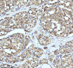 Immunohistochemical staining of IGFL3 using anti-IGFL3 antibody. IGFL3 was detected in a paraffin-embedded section of human thyroid cancer tissue. Heat mediated antigen retrieval was performed in EDTA buffer (pH 8.0, epitope retrieval solution). The tissue section was blocked with 10% goat serum. The tissue section was then incubated with 2 ug/ml rabbit anti-IGFL3 antibody overnight at 4oC. Peroxidase Conjugated Goat Anti-rabbit IgG was used as secondary antibody and incubated for 30 minutes at 37oC. The tissue section was developed using an HRP secondary and DAB substrate.