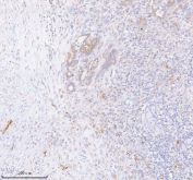 Immunohistochemical staining of INTS4 using anti-INTS4 antibody. INTS4 was detected in a paraffin-embedded section of human thyroid cancer tissue. Heat mediated antigen retrieval was performed in EDTA buffer (pH 8.0, epitope retrieval solution). The tissue section was blocked with 10% goat serum. The tissue section was then incubated with 2 ug/ml rabbit anti-INTS4 antibody overnight at 4oC. Peroxidase Conjugated Goat Anti-rabbit IgG was used as secondary antibody and incubated for 30 minutes at 37oC. The tissue section was developed using an HRP secondary and DAB substrate.