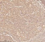 Immunohistochemical staining of NUP43 using anti-NUP43 antibody. NUP43 was detected in a paraffin-embedded section of human colon adenocarcinoma tissue. Heat mediated antigen retrieval was performed in EDTA buffer (pH 8.0, epitope retrieval solution). The tissue section was blocked with 10% goat serum. The tissue section was then incubated with 2 ug/ml rabbit anti-NUP43 antibody overnight at 4oC. Peroxidase Conjugated Goat Anti-rabbit IgG was used as secondary antibody and incubated for 30 minutes at 37oC. The tissue section was developed using an HRP secondary and DAB substrate.