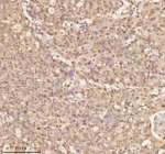 Immunohistochemical staining of NUP43 using anti-NUP43 antibody. NUP43 was detected in a paraffin-embedded section of human colon adenocarcinoma tissue. Heat mediated antigen retrieval was performed in EDTA buffer (pH 8.0, epitope retrieval solution). The tissue section was blocked with 10% goat serum. The tissue section was then incubated with 2 ug/ml rabbit anti-NUP43 antibody overnight at 4oC. Peroxidase Conjugated Goat Anti-rabbit IgG was used as secondary antibody and incubated for 30 minutes at 37oC. The tissue section was developed using an HRP secondary and DAB substrate.