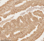 Immunohistochemical staining of NUP43 using anti-NUP43 antibody. NUP43 was detected in a paraffin-embedded section of human endometrioid adenocarcinoma tissue. Heat mediated antigen retrieval was performed in EDTA buffer (pH 8.0, epitope retrieval solution). The tissue section was blocked with 10% goat serum. The tissue section was then incubated with 2 ug/ml rabbit anti-NUP43 antibody overnight at 4oC. Peroxidase Conjugated Goat Anti-rabbit IgG was used as secondary antibody and incubated for 30 minutes at 37oC. The tissue section was developed using an HRP secondary and DAB substrate.