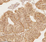 Immunohistochemical staining of NUP43 using anti-NUP43 antibody. NUP43 was detected in a paraffin-embedded section of human endometrioid adenocarcinoma tissue. Heat mediated antigen retrieval was performed in EDTA buffer (pH 8.0, epitope retrieval solution). The tissue section was blocked with 10% goat serum. The tissue section was then incubated with 2 ug/ml rabbit anti-NUP43 antibody overnight at 4oC. Peroxidase Conjugated Goat Anti-rabbit IgG was used as secondary antibody and incubated for 30 minutes at 37oC. The tissue section was developed using an HRP secondary and DAB substrate.