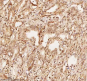 Immunohistochemical staining of NUP43 using anti-NUP43 antibody. NUP43 was detected in a paraffin-embedded section of human prostate adenocarcinoma tissue. Heat mediated antigen retrieval was performed in EDTA buffer (pH 8.0, epitope retrieval solution). The tissue section was blocked with 10% goat serum. The tissue section was then incubated with 2 ug/ml rabbit anti-NUP43 antibody overnight at 4oC. Peroxidase Conjugated Goat Anti-rabbit IgG was used as secondary antibody and incubated for 30 minutes at 37oC. The tissue section was developed using an HRP secondary and DAB substrate.