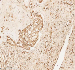 Immunohistochemical staining of NUP43 using anti-NUP43 antibody. NUP43 was detected in a paraffin-embedded section of human lung adenocarcinoma tissue. Heat mediated antigen retrieval was performed in EDTA buffer (pH 8.0, epitope retrieval solution). The tissue section was blocked with 10% goat serum. The tissue section was then incubated with 2 ug/ml rabbit anti-NUP43 antibody overnight at 4oC. Peroxidase Conjugated Goat Anti-rabbit IgG was used as secondary antibody and incubated for 30 minutes at 37oC. The tissue section was developed using an HRP secondary and DAB substrate.