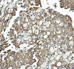Immunohistochemical staining of SEC61G using anti-SEC61G antibody. SEC61G was detected in a paraffin-embedded section of human liver cancer tissue. Heat mediated antigen retrieval was performed in EDTA buffer (pH 8.0, epitope retrieval solution). The tissue section was blocked with 10% goat serum. The tissue section was then incubated with 2 ug/ml rabbit anti-SEC61G antibody overnight at 4oC. Peroxidase Conjugated Goat Anti-rabbit IgG was used as secondary antibody and incubated for 30 minutes at 37oC. The tissue section was developed using an HRP secondary and DAB substrate.