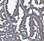 Immunohistochemical staining of SEC61G using anti-SEC61G antibody. SEC61G was detected in a paraffin-embedded section of human ovarian cancer tissue. Heat mediated antigen retrieval was performed in EDTA buffer (pH 8.0, epitope retrieval solution). The tissue section was blocked with 10% goat serum. The tissue section was then incubated with 2 ug/ml rabbit anti-SEC61G antibody overnight at 4oC. Peroxidase Conjugated Goat Anti-rabbit IgG was used as secondary antibody and incubated for 30 minutes at 37oC. The tissue section was developed using an HRP secondary and DAB substrate.