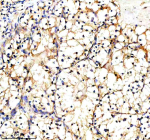Immunohistochemical staining of PXDN using anti-PXDN antibody. PXDN was detected in a paraffin-embedded section of human clear cell renal cell carcinoma tissue. Heat mediated antigen retrieval was performed in EDTA buffer (pH 8.0, epitope retrieval solution). The tissue section was blocked with 10% goat serum. The tissue section was then incubated with 2 ug/ml rabbit anti-PXDN antibody overnight at 4oC. Peroxidase Conjugated Goat Anti-rabbit IgG was used as secondary antibody and incubated for 30 minutes at 37oC. The tissue section was developed using an HRP secondary and DAB substrate.
