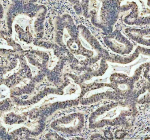 Immunohistochemical staining of NASP using anti-NASP antibody. NASP was detected in a paraffin-embedded section of human stomach cancer tissue. Heat mediated antigen retrieval was performed in EDTA buffer (pH 8.0, epitope retrieval solution). The tissue section was blocked with 10% goat serum. The tissue section was then incubated with 2 ug/ml rabbit anti-NASP antibody overnight at 4oC. Peroxidase Conjugated Goat Anti-rabbit IgG was used as secondary antibody and incubated for 30 minutes at 37oC. The tissue section was developed using an HRP secondary and DAB substrate.