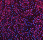 Immunofluorescent staining of NASP using anti-NASP antibody (red). NASP was detected in a paraffin-embedded section of human stomach cancer tissue. Heat mediated antigen retrieval was performed in EDTA buffer (pH 8.0, epitope retrieval solution). The tissue section was blocked with 10% goat serum. The tissue section was then incubated with 5 ug/ml rabbit anti-NASP antibody overnight at 4oC. Cy3 Conjugated Goat Anti-Rabbit IgG was used as secondary antibody at 1:500 dilution and incubated for 30 minutes at 37oC. The section was counterstained with DAPI nuclear stain (blue). Visualize using a fluorescence microscope and filter sets appropriate for the label used.