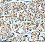Immunohistochemical staining of SMG8 using anti-SMG8 antibody. SMG8 was detected in a paraffin-embedded section of human liver cancer tissue. Heat mediated antigen retrieval was performed in EDTA buffer (pH 8.0, epitope retrieval solution). The tissue section was blocked with 10% goat serum. The tissue section was then incubated with 2 ug/ml rabbit anti-SMG8 antibody overnight at 4oC. Peroxidase Conjugated Goat Anti-rabbit IgG was used as secondary antibody and incubated for 30 minutes at 37oC. The tissue section was developed using an HRP secondary and DAB substrate.
