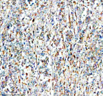 Immunohistochemical staining of SMG8 using anti-SMG8 antibody. SMG8 was detected in a paraffin-embedded section of human stomach cancer tissue. Heat mediated antigen retrieval was performed in EDTA buffer (pH 8.0, epitope retrieval solution). The tissue section was blocked with 10% goat serum. The tissue section was then incubated with 2 ug/ml rabbit anti-SMG8 antibody overnight at 4oC. Peroxidase Conjugated Goat Anti-rabbit IgG was used as secondary antibody and incubated for 30 minutes at 37oC. The tissue section was developed using an HRP secondary and DAB substrate.