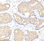 Immunohistochemical staining of BMPR1A using anti-BMPR1A antibody. BMPR1A was detected in a paraffin-embedded section of human breast cancer tissue. Heat mediated antigen retrieval was performed in EDTA buffer (pH 8.0, epitope retrieval solution). The tissue section was blocked with 10% goat serum. The tissue section was then incubated with 2 ug/ml rabbit anti-BMPR1A antibody overnight at 4oC. Peroxidase Conjugated Goat Anti-rabbit IgG was used as secondary antibody and incubated for 30 minutes at 37oC. The tissue section was developed using an HRP secondary and DAB substrate.