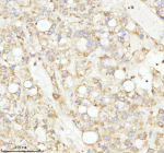 Immunohistochemical staining of NRTN using anti-NRTN antibody. NRTN was detected in a paraffin-embedded section of human liver cancer tissue. Heat mediated antigen retrieval was performed in EDTA buffer (pH 8.0, epitope retrieval solution). The tissue section was blocked with 10% goat serum. The tissue section was then incubated with 2 ug/ml rabbit anti-NRTN antibody overnight at 4oC. Peroxidase Conjugated Goat Anti-rabbit IgG was used as secondary antibody and incubated for 30 minutes at 37oC. The tissue section was developed using an HRP secondary and DAB substrate.
