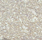 Immunohistochemical staining of NRTN using anti-NRTN antibody. NRTN was detected in a paraffin-embedded section of human liver cancer tissue. Heat mediated antigen retrieval was performed in EDTA buffer (pH 8.0, epitope retrieval solution). The tissue section was blocked with 10% goat serum. The tissue section was then incubated with 2 ug/ml rabbit anti-NRTN antibody overnight at 4oC. Peroxidase Conjugated Goat Anti-rabbit IgG was used as secondary antibody and incubated for 30 minutes at 37oC. The tissue section was developed using an HRP secondary and DAB substrate.