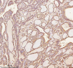 Immunohistochemical staining of NRTN using anti-NRTN antibody. NRTN was detected in a paraffin-embedded section of human thyroid papillary carcinoma tissue. Heat mediated antigen retrieval was performed in EDTA buffer (pH 8.0, epitope retrieval solution). The tissue section was blocked with 10% goat serum. The tissue section was then incubated with 2 ug/ml rabbit anti-NRTN antibody overnight at 4oC. Peroxidase Conjugated Goat Anti-rabbit IgG was used as secondary antibody and incubated for 30 minutes at 37oC. The tissue section was developed using an HRP secondary and DAB substrate.